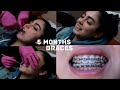 5 MONTHS BRACES UPDATE (POWERCHAINS)