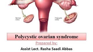 PCOS part-1 Dr. Rasha saadi gynecology