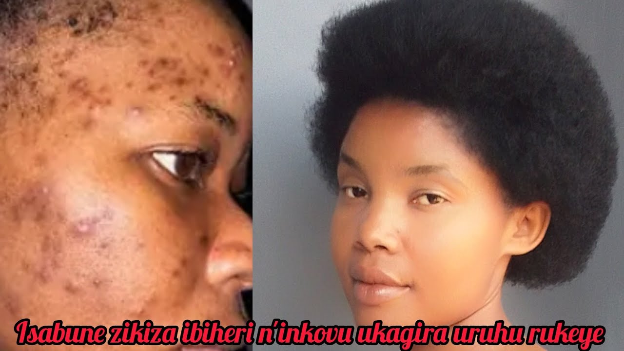 Isabune enye zihendutse kandi zizewe mugukiza ibiheri n'inkovu ukagira uruhu rukeye runoze