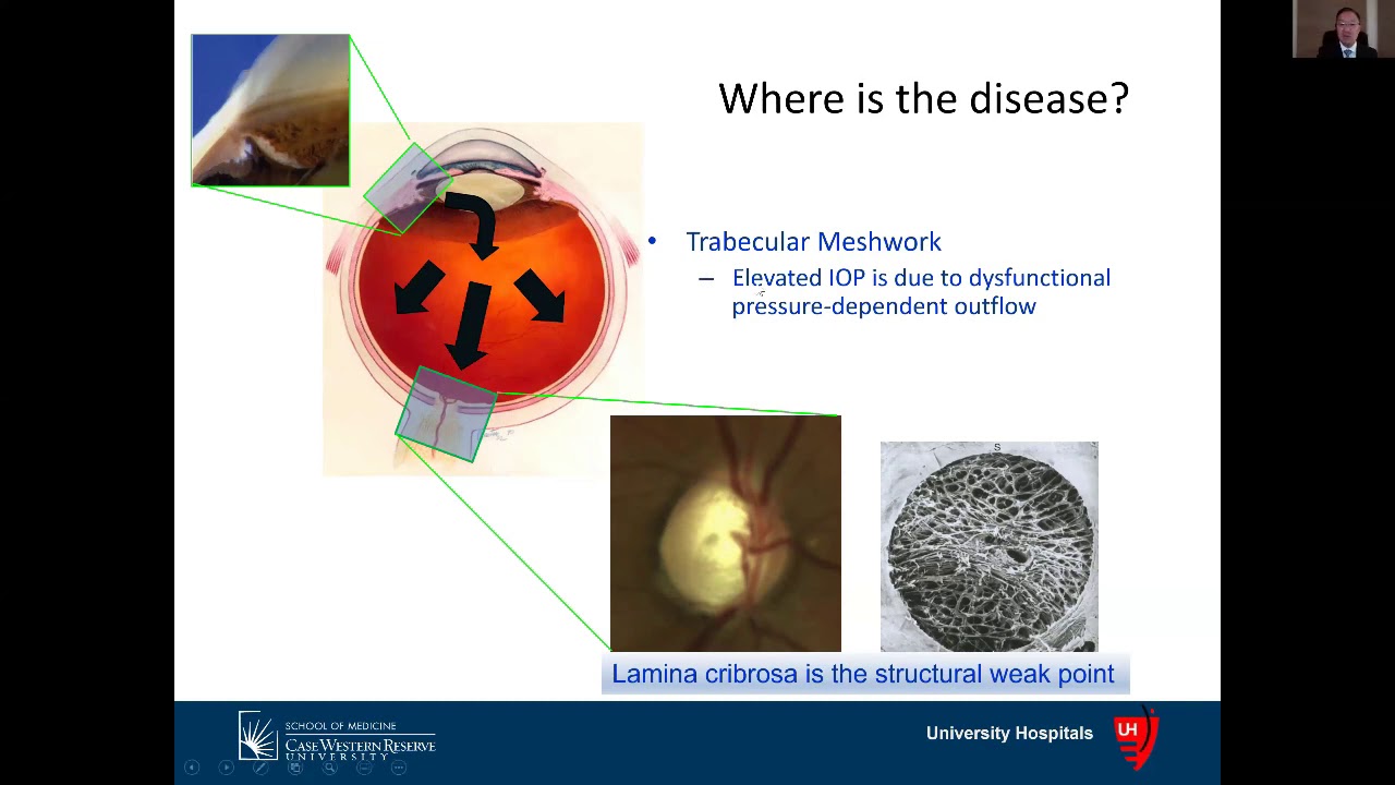 SESIÓN VIRTUAL CAPÍTULO DE GLAUCOMA - DR. DOUGLAS J. RHEE (USA) - YouTube