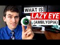 What is lazy eye amblyopia and what causes it