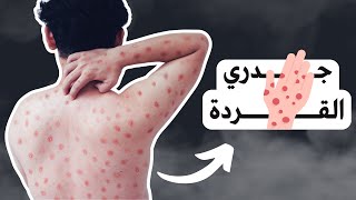 مرض جدري القردة | الحقائق الكاملة