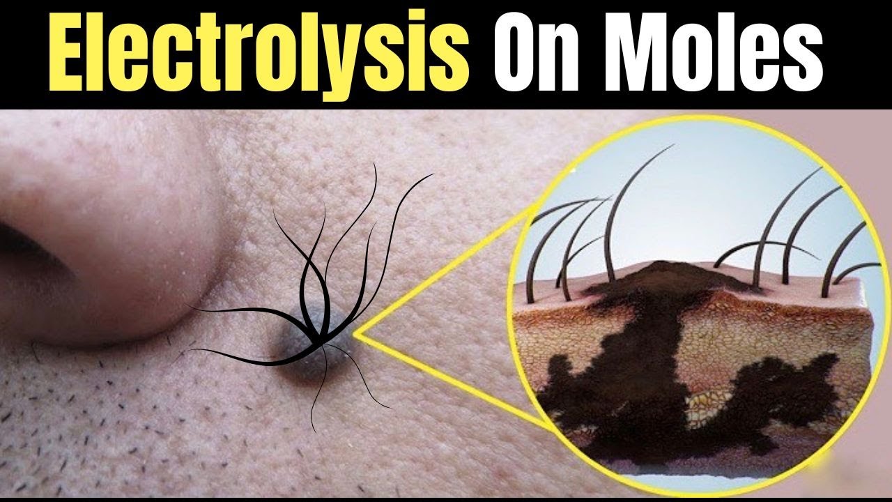 Electrolysis On Mole YouTube