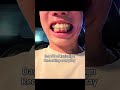day58 #braces #dentist #smile #journey