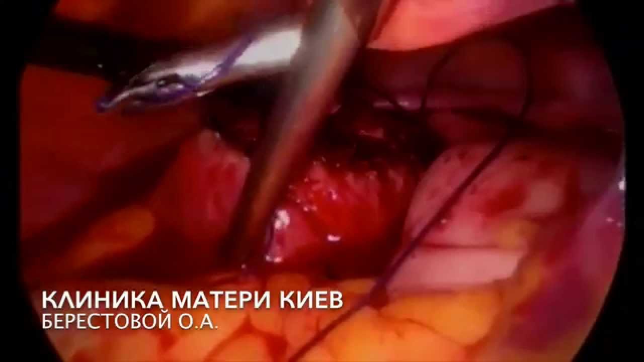 +21 УНИКАЛЬНЫЙ РЕДЧАЙШИЙ случай беременность в ЯИЧНИКЕ. ОПЕРАЦИЯ! УЗИ!