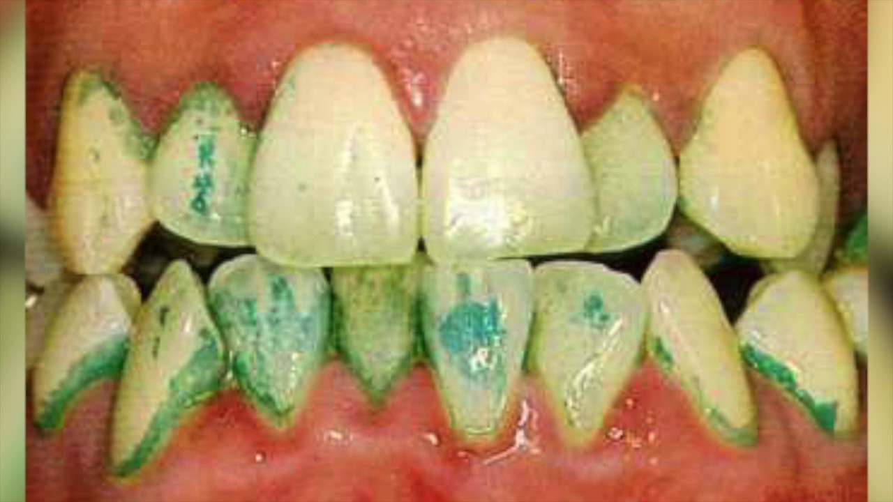 Índice de placa de Löe y Silness, Índice de Quigley – Hein, Índice simplificado de higiene oral