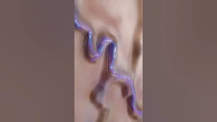 Varicose Vein Treatment