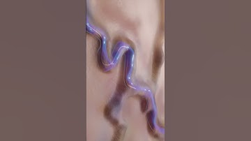 Varicose Vein Treatment