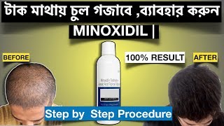 Minoxidil for Hair Regrowth . টাক মাথায় কি ভাবে চুল গজাবে ? কি ভাবে চুল ঝড়া বন্দ করবেন ?