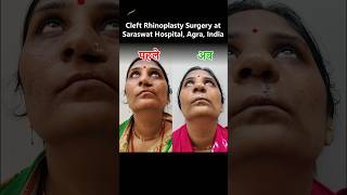 Cleft Rhinoplasty Surgery by Dr. Satya Saraswat Agra, India