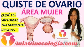QUISTE DE OVARIO QUE ES SINTOMAS TRATAMIENTO RIESGOS Ginecologia y Obstetricia
