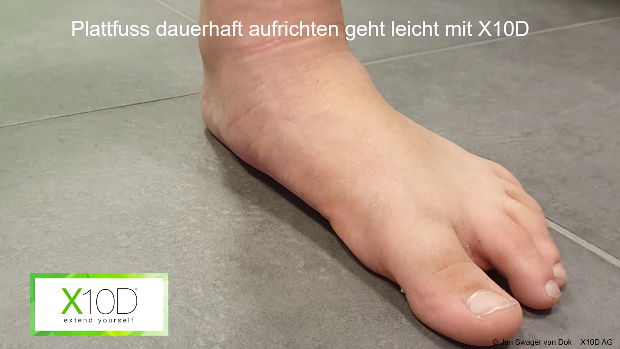 Plattfuss Aufrichten YouTube