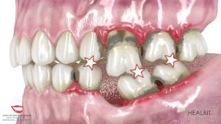 La Prótesis Dental Fija