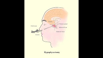 Craniotomy for craniosynostosis CPT code - simplify medical coding