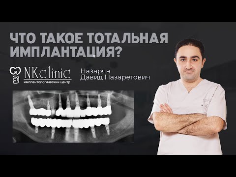 Что такое тотальная имплантация зубов? Ответы врача