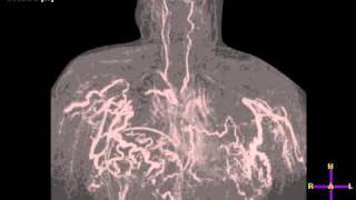 Details TR CHEST SVC.avi Guide