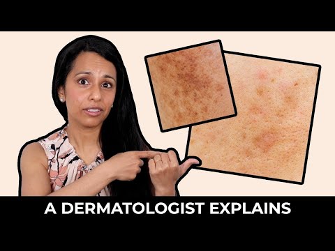 What is Post-Inflammatory Hyperpigmentation? | How to Treat Post-Inflammatory Hyperpigmentation