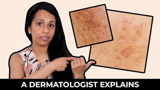 What is Post-Inflammatory Hyperpigmentation? | How to Treat Post-Inflammatory Hyperpigmentation