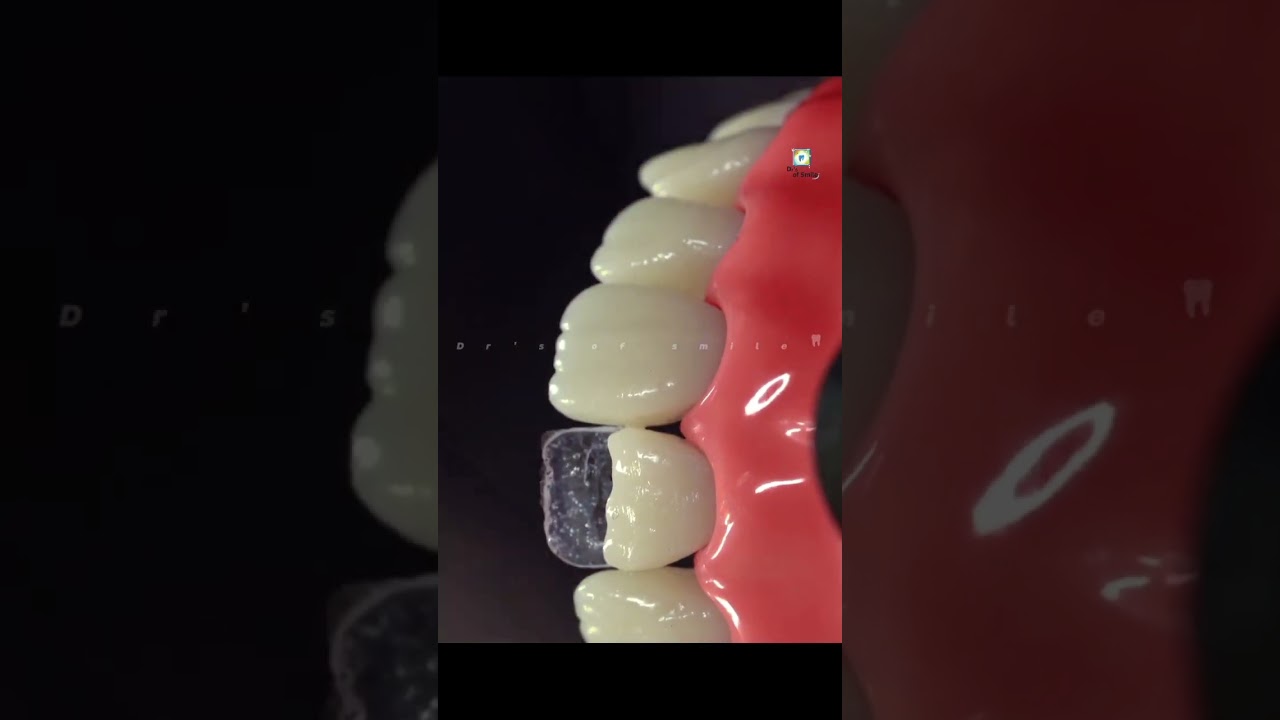 upper central incisor tooth direct composite restoration 
