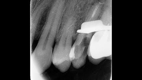 direct injection technique - squirt obturation of an upper bicuspid