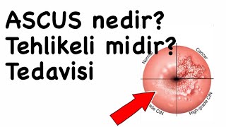 Ascus Nedir? Neden Olur? Tehlikeli Mi? Ascus Smear Tedavisi Ascus Ve Hpv Pozitif Yönetimi Takip