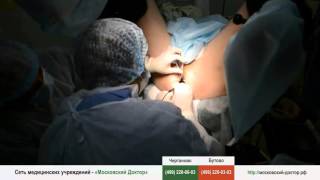 Иссечение анальной трещины операция