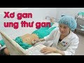 Xơ gan: Điều Trị & Phòng Ngừa Ung thư gan