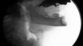 CLIP 1 penetration of liquid before the swallow secondary to premature loss