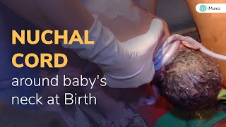 Nuchal Cord around baby's neck at Birth | Is normal delivery possible? | iMumz