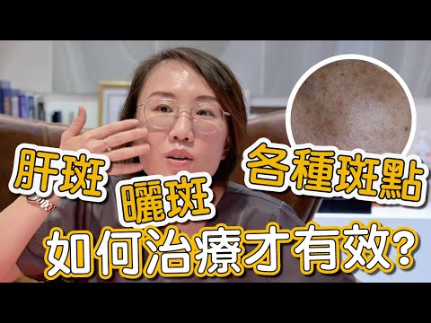 肝斑、色素不均是如何造成？來看看莊盈彥醫師治療肝斑的方式有哪些！