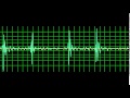 Prosthetic mitral valve closing click slow