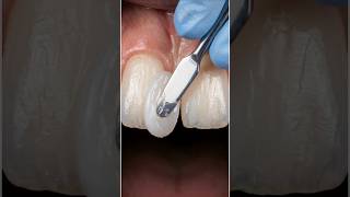 Oddly Satisfying: Closing a HUGE Tooth Gap! 🪄