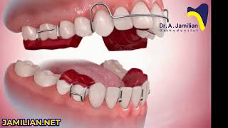 Twin Block Functional Appliance: Advancing  Lower Jaw in Growing Kids for Future Growth #functional