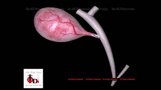 Cholecysis Formation Laparoscopic Cholecystectomy Dr.tulips Hospital
