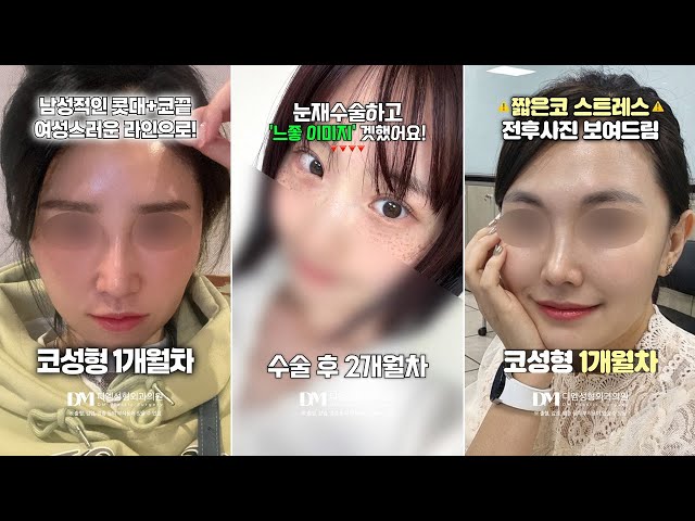 눈재수술 잘 하는 곳 찾고 있어?👀 ｜ 성형 쇼츠 모음▶️