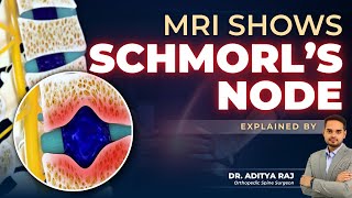 MRI Shows Schmorl’s Node | Explained by Spine Specialist | Dr. Aditya Raj | Synapse Spine