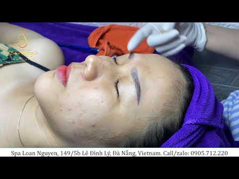 Treatment blackheads for girl (238) | Loan Nguyen