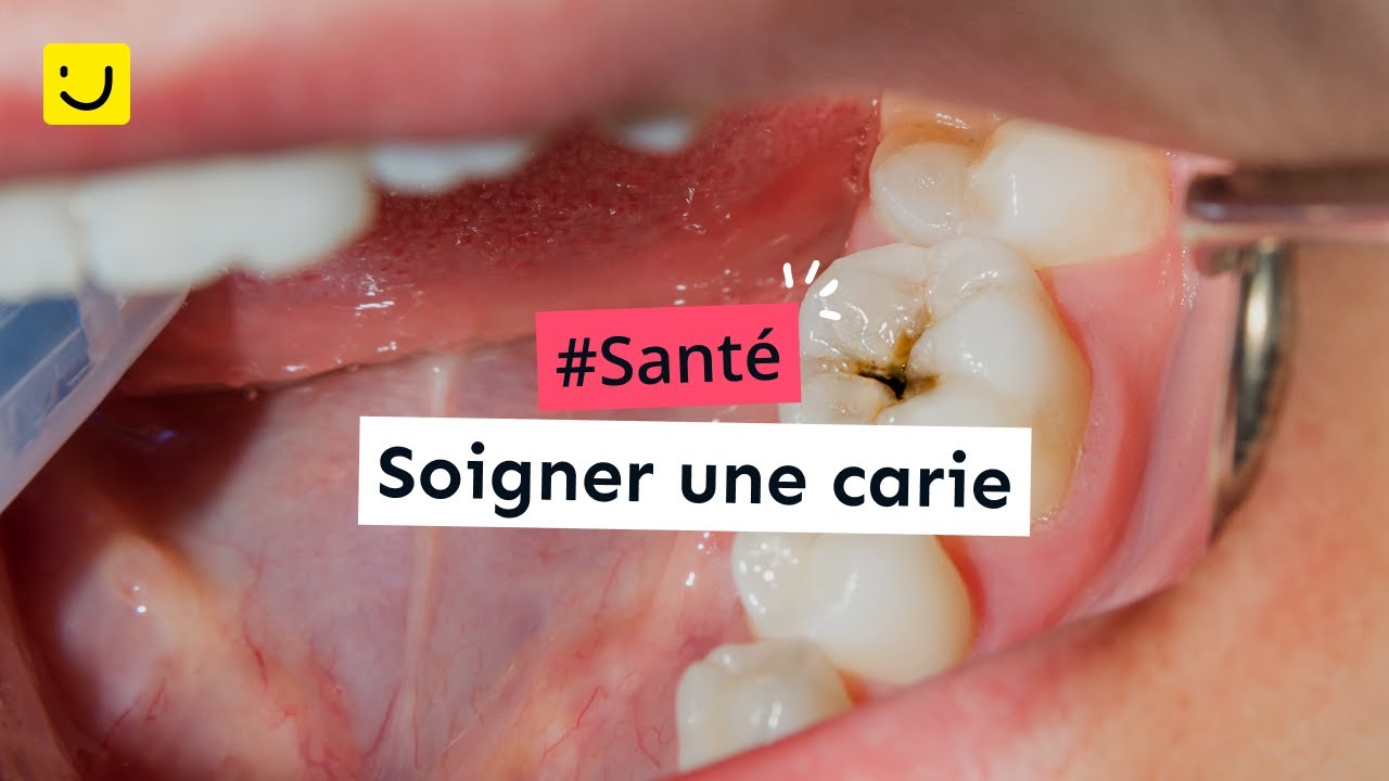 Comment Faire Ton Pour Avoir Des Caries