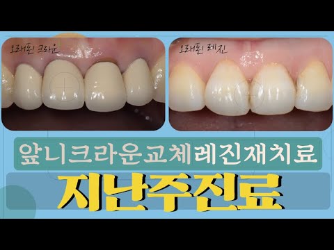 앞니크라운 교체(<strong>올세라믹</strong>) / 레진 재치료 / 캔틸레버브릿지 교체치료