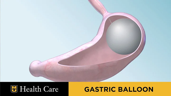 Bariatric Surgery Seminar: Gastric Balloon