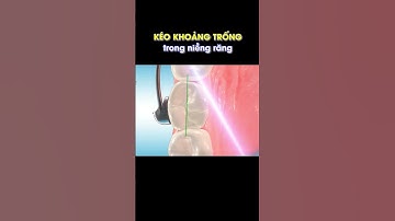 Kéo tạo khoảng trống trong niềng răng