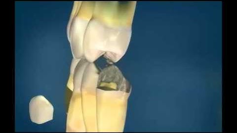 Gold Crowns - Miskin Ajax Dental