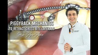 piggyback mechanics to retract cross bite laterals in orthodontics