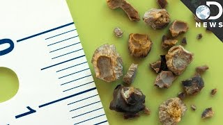 Everything You Need To Know About Kidney Stones