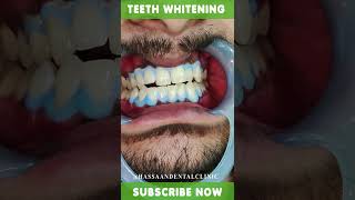 teeth whitening (2022)