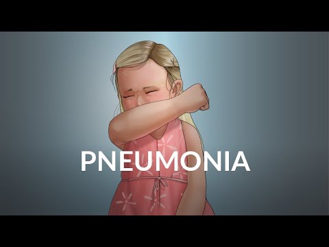 "Pneumonia" by Brian Fissel and Dr. Patricia Stoeck