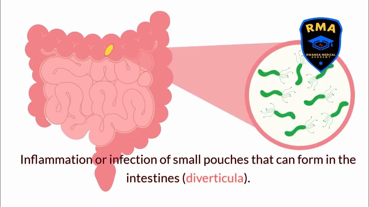 Right Lower Quadrant Pain Differentials Mnemonic APPENDICITIS with