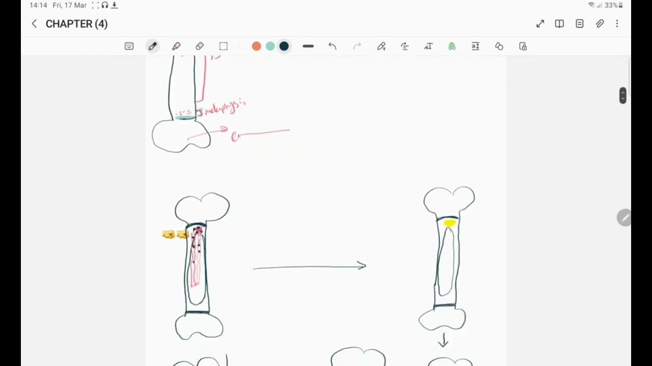 Osteomyelitis pathology YouTube