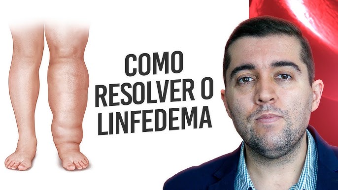 Saiba Quais os 8 Sinais que Indicam Lipedema. Saúde das suas