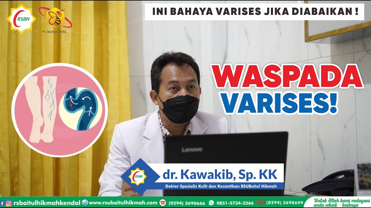 WASPADA VARISES ! PENYEBAB GEJALA DAN CARA MENGATASI VARISES - dr